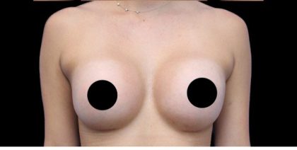 Breast Augmentation Before & After Patient #422