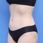 Liposuction/Liposculpture Before & After Patient #596