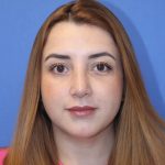 Primary Rhinoplasty Before & After Patient #776