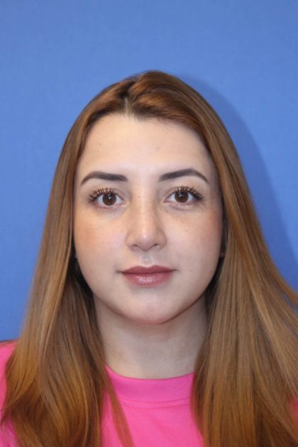 Primary Rhinoplasty Before & After Patient #776