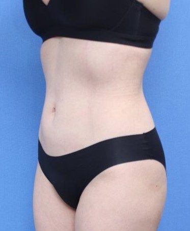 Liposuction/Liposculpture Before & After Patient #596