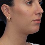 Primary Rhinoplasty Before & After Patient #805