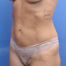Liposuction/Liposculpture Before & After Patient #597