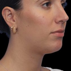 Primary Rhinoplasty Before & After Patient #805