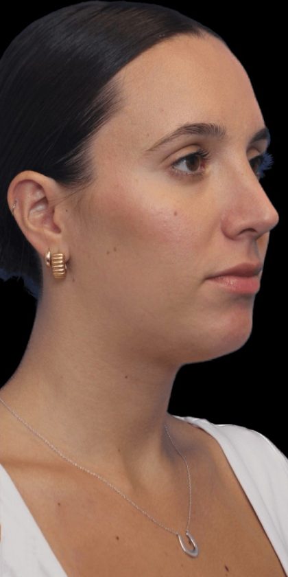 Primary Rhinoplasty Before & After Patient #805