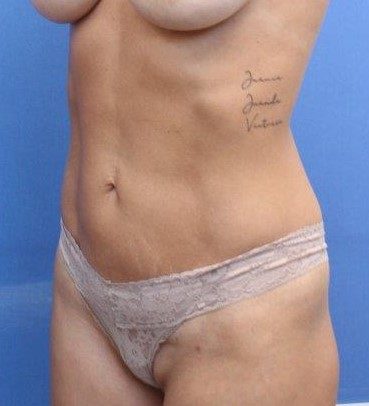 Liposuction/Liposculpture Before & After Patient #597