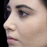 Primary Rhinoplasty Before & After Patient #808