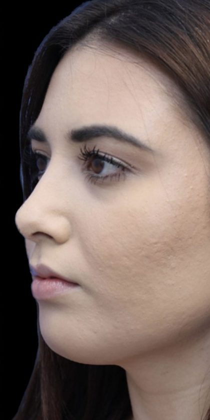 Primary Rhinoplasty Before & After Patient #808