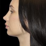 Primary Rhinoplasty Before & After Patient #824