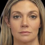 Primary Rhinoplasty Before & After Patient #825