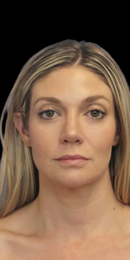 Primary Rhinoplasty Before & After Patient #825