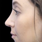 Primary Rhinoplasty Before & After Patient #855
