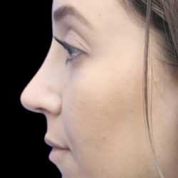 Primary Rhinoplasty Before & After Patient #855