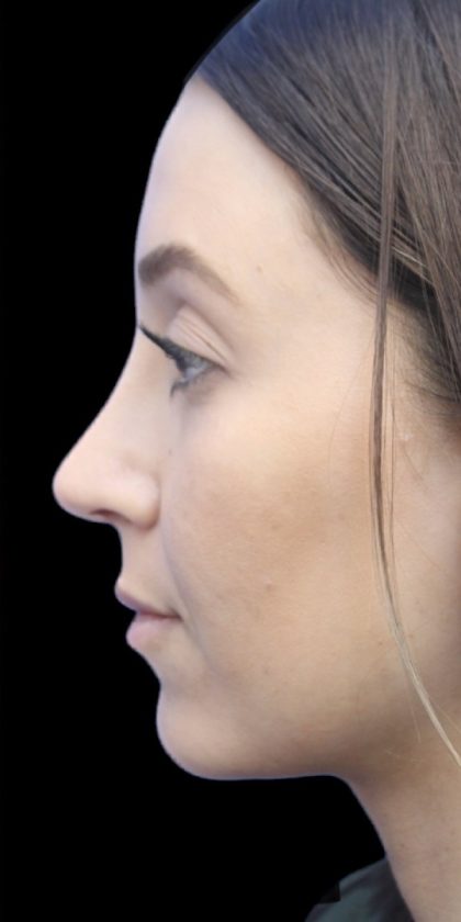 Primary Rhinoplasty Before & After Patient #855