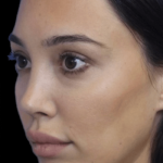 Primary Rhinoplasty Before & After Patient #807