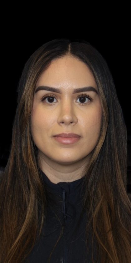 Primary Rhinoplasty Before & After Patient #856