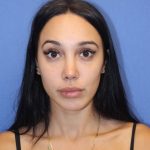 Revision Rhinoplasty Before & After Patient #875