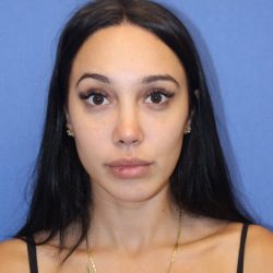 Revision Rhinoplasty Before & After Patient #875