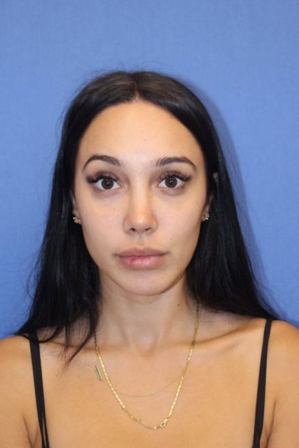 Revision Rhinoplasty Before & After Patient #875