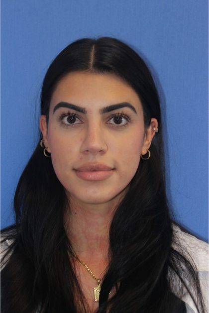 Revision Rhinoplasty Before & After Patient #876