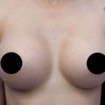 Breast Augmentation Before & After Patient #494