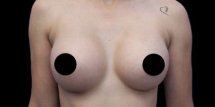Breast Augmentation Before & After Patient #494