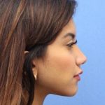 Primary Rhinoplasty Before & After Patient #744