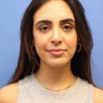 Primary Rhinoplasty Before & After Patient #774