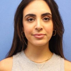 Primary Rhinoplasty Before & After Patient #774