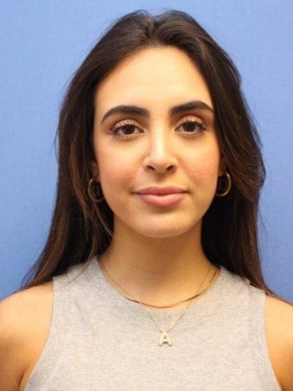 Primary Rhinoplasty Before & After Patient #774