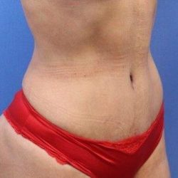 Tummy Tuck Before & After Patient #893