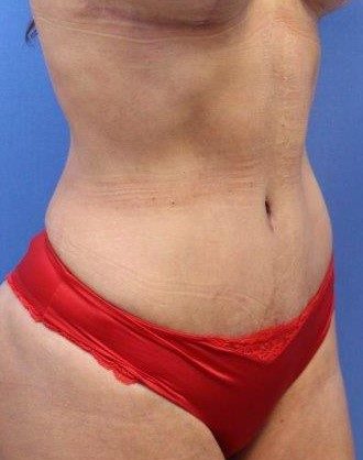 Tummy Tuck Before & After Patient #893