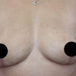 Breast Lift Before & After Patient #538