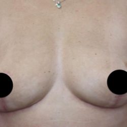 Breast Lift Before & After Patient #538