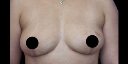 Breast Lift Before & After Patient #538