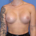 Breast Augmentation Before & After Patient #420