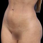 Liposuction/Liposculpture Before & After Patient #604