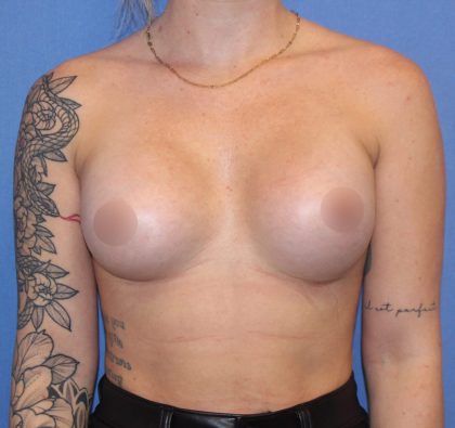 Breast Augmentation Before & After Patient #420