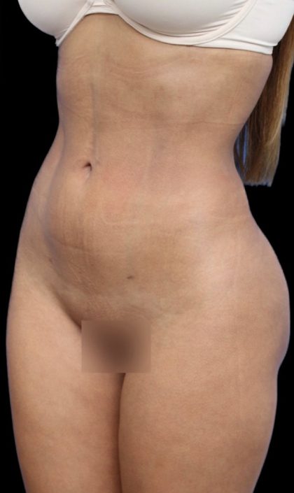 Liposuction/Liposculpture Before & After Patient #604