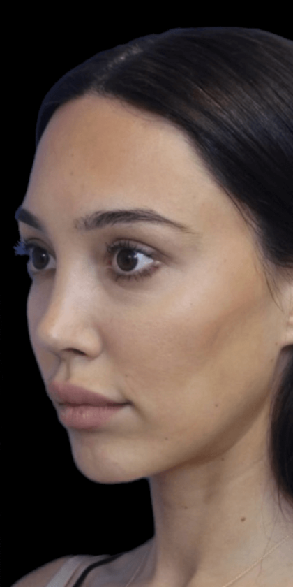 Primary Rhinoplasty Before & After Patient #807
