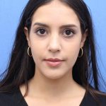 Primary Rhinoplasty Before & After Patient #741
