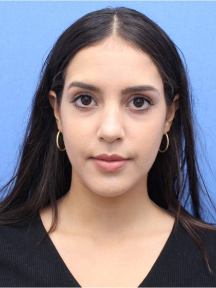 Primary Rhinoplasty Before & After Patient #741
