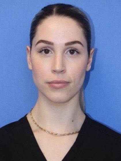 Primary Rhinoplasty Before & After Patient #743