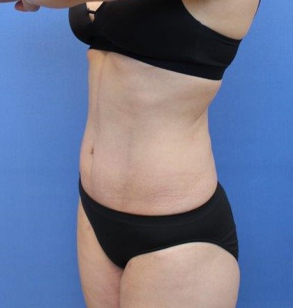 Liposuction/Liposculpture Before & After Patient #594