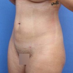 Liposuction/Liposculpture Before & After Patient #595