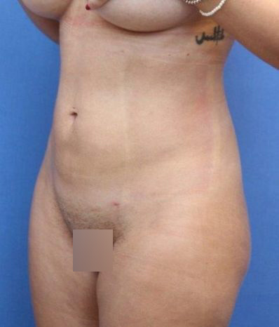 Liposuction/Liposculpture Before & After Patient #595
