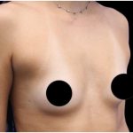 Breast Augmentation Before & After Patient #422