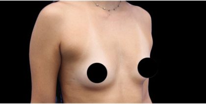 Breast Augmentation Before & After Patient #422