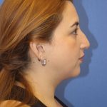 Primary Rhinoplasty Before & After Patient #776