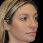 Primary Rhinoplasty Before & After Patient #825